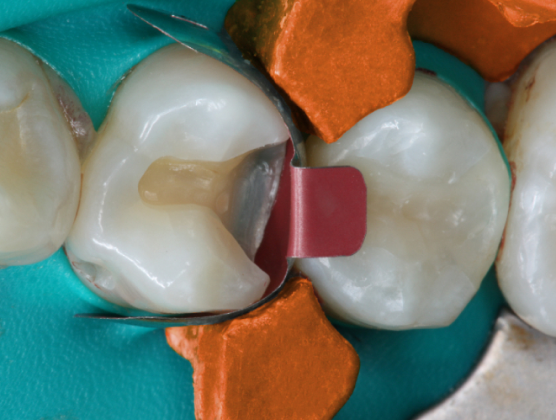 Per Ortodonzia Laboratorio Kit Strisce Per Riduzione Interprossimale Dentale - 10 Pezzi Easyinsmile, Per Ortodonzia DPI Per Ortodonzia