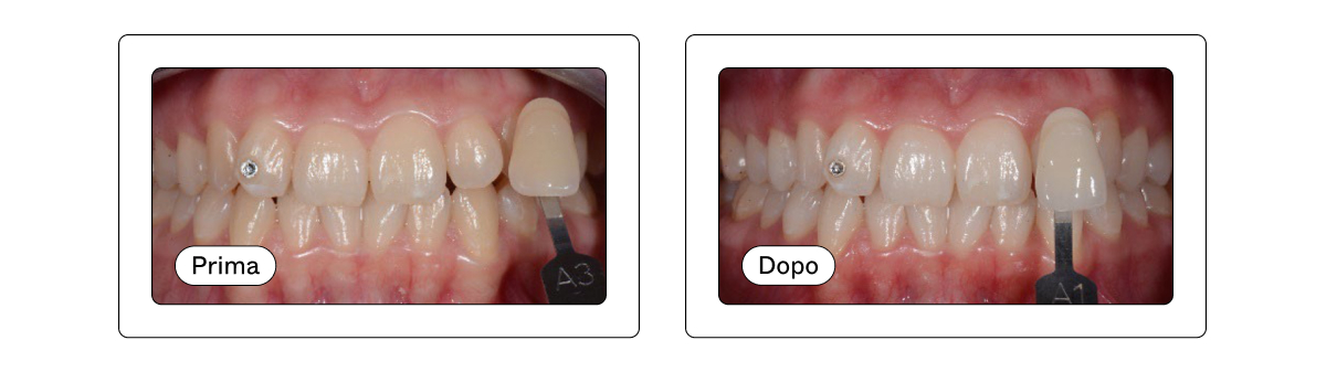 before after blog Amodeo